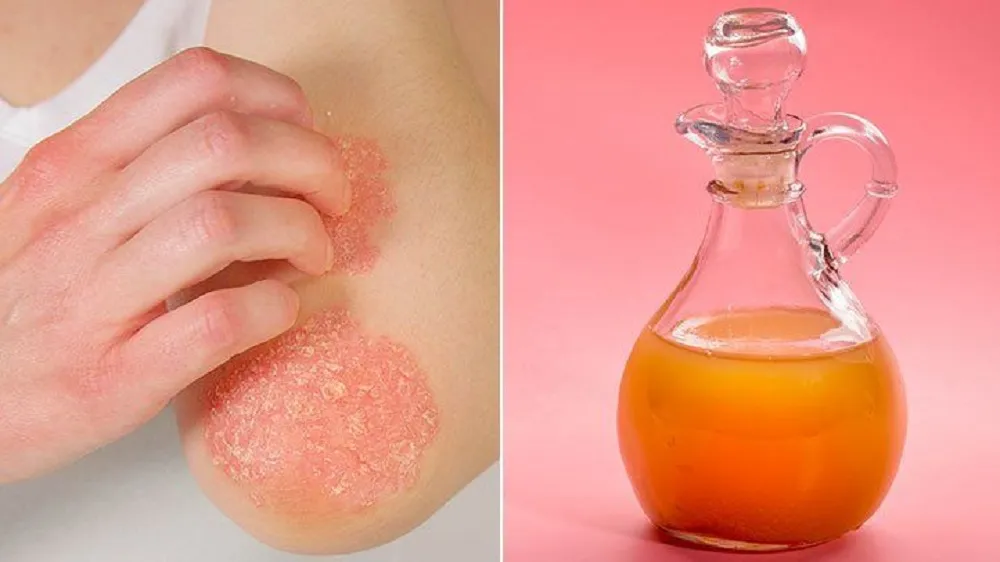 How to Use Apple Cider Vinegar for Skin