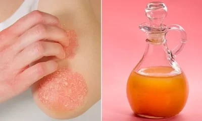 How to Use Apple Cider Vinegar for Skin