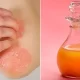 How to Use Apple Cider Vinegar for Skin